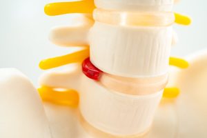 bel fıtığı seviyeleri