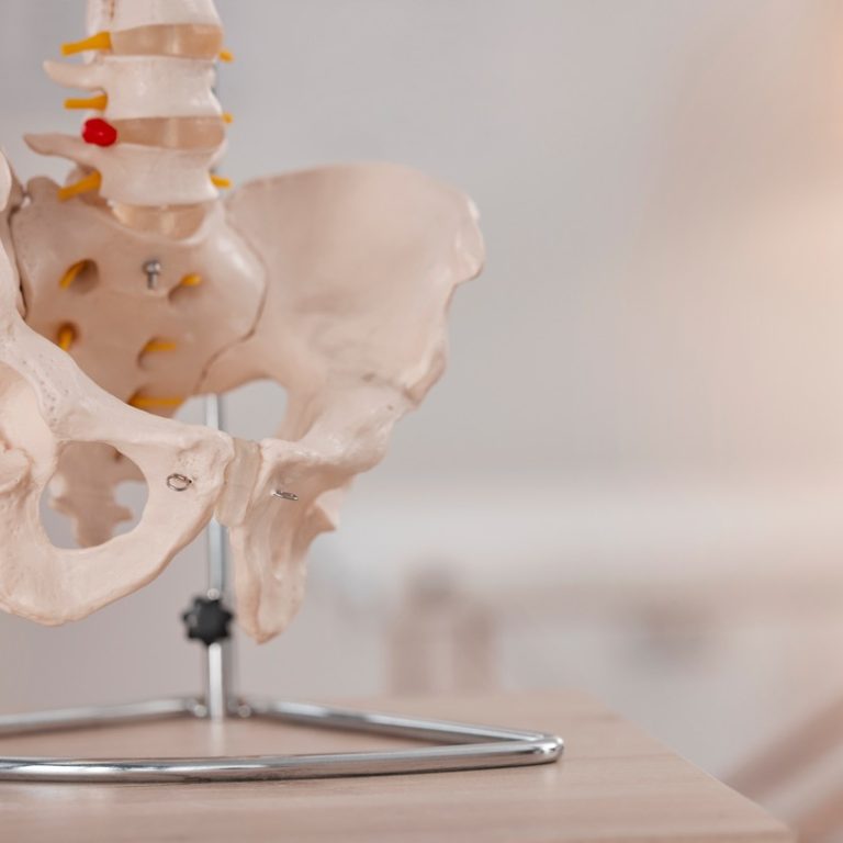 Sakroiliak Eklem Kireçlenmesi Belirtileri ve Tedavi Yöntemleri