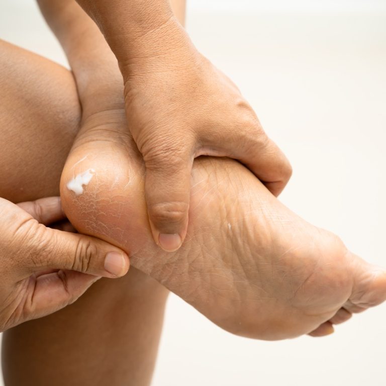 ayak altında sinir sıkışması