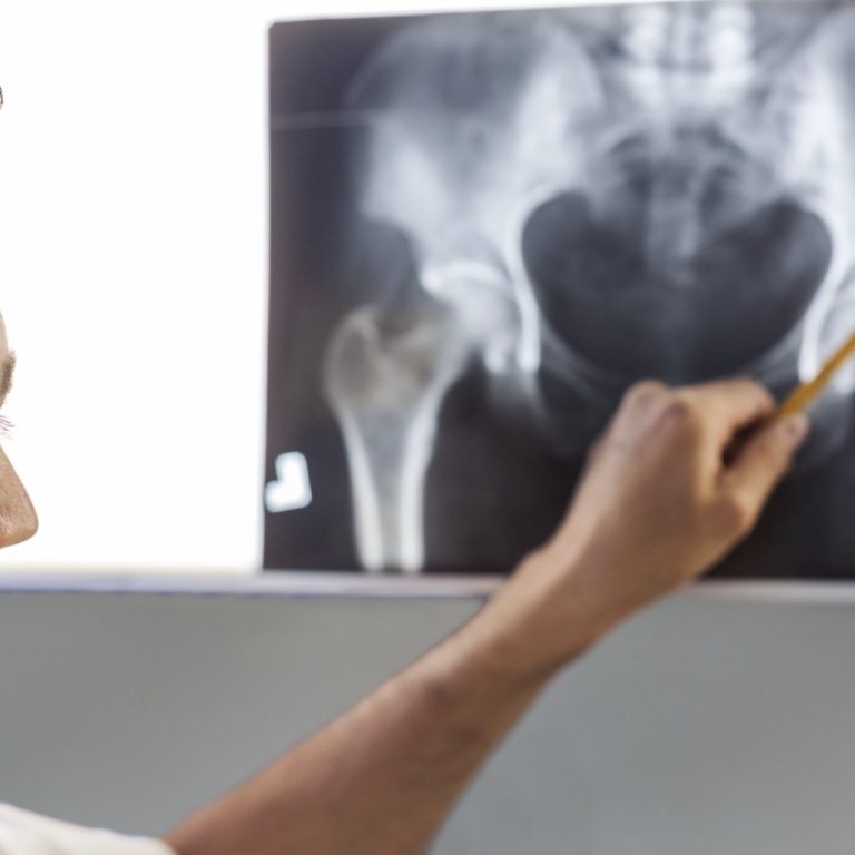 kalçalarda kireçlenme