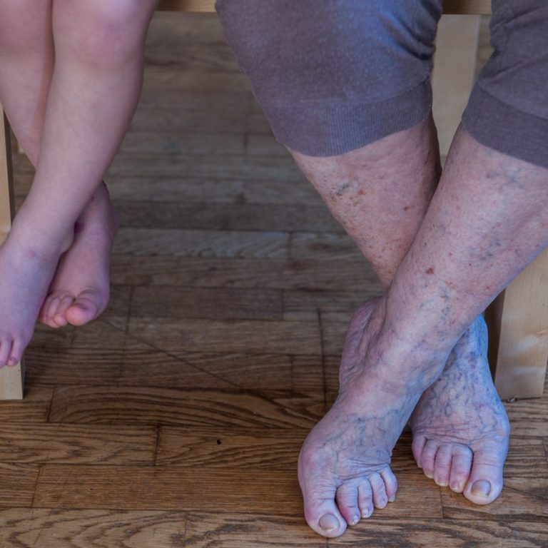 lenfödem masaji nasil yapilir